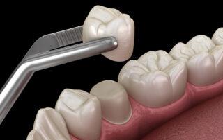 What are Dental Crowns