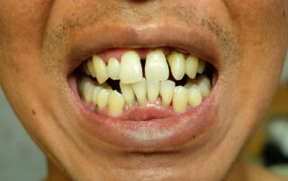 Are Bad Teeth Genetic?