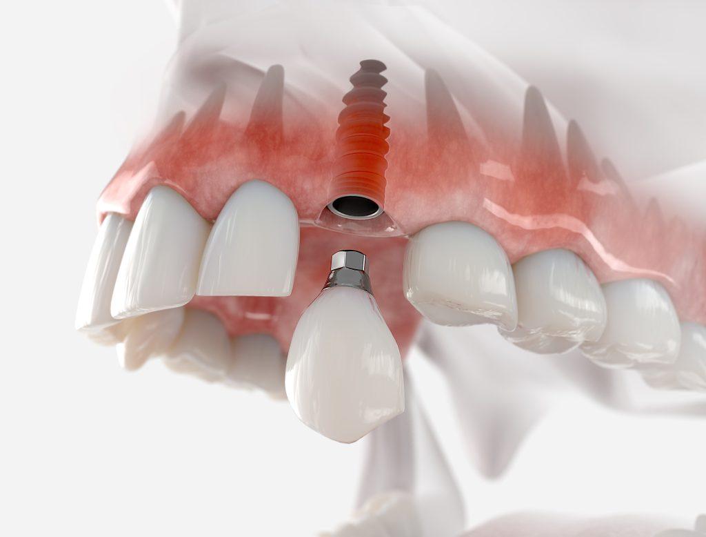 Dental implants Richmond - The Practice At Mortlake
